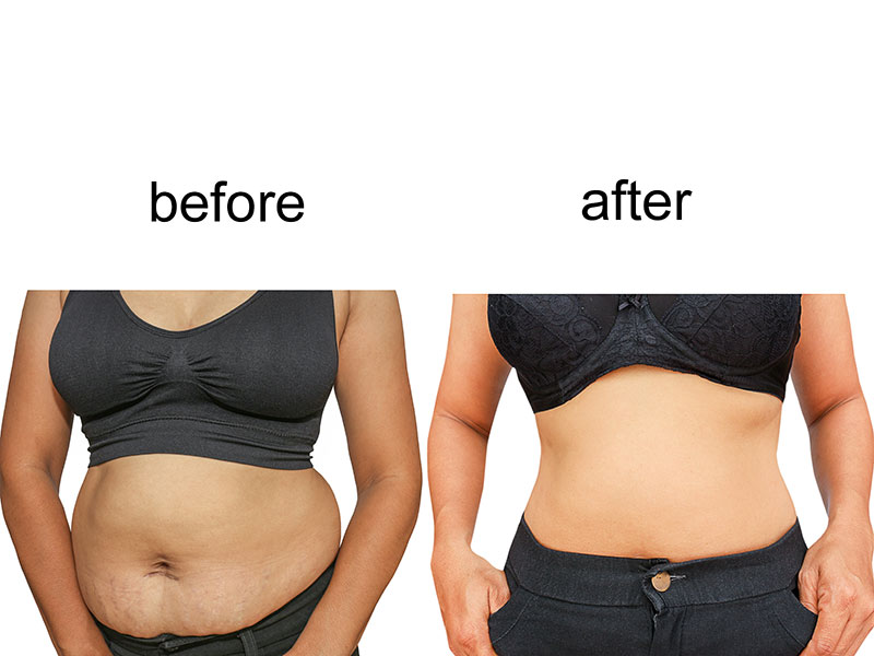 Best Weight Loss Clinic in Delhi - Weight Loss Treatment